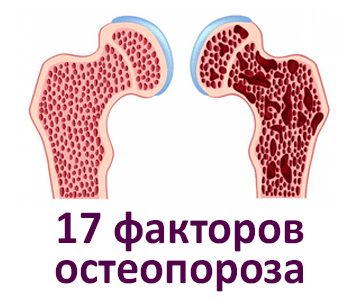 17 факторов остеопороза